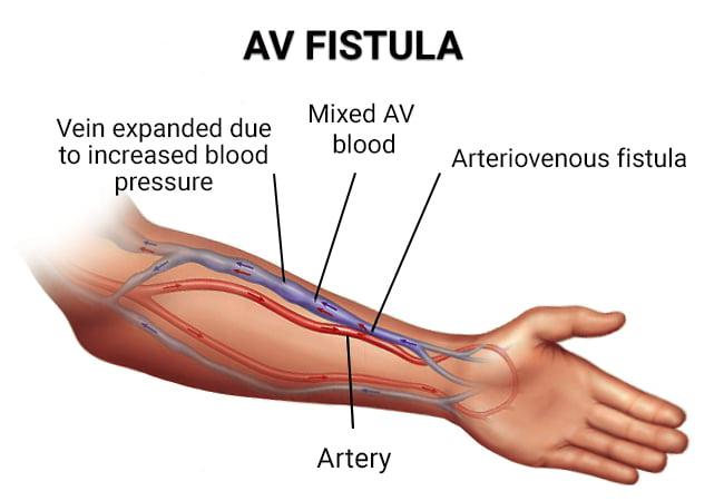 What is AV Fistula and Why It is Important to Create Timely Fistula in ESRD Patients